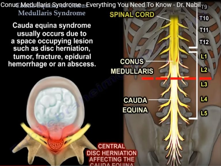 Cauda Equina Syndrome Vs Conus Medullaris Syndrome Orthopaedicprinciples Com