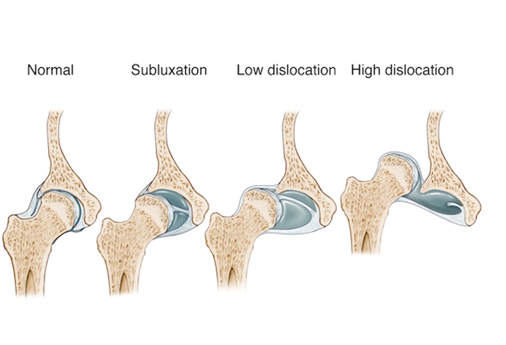 Challenges in THR for Dysplastic Hips — OrthopaedicPrinciples.com