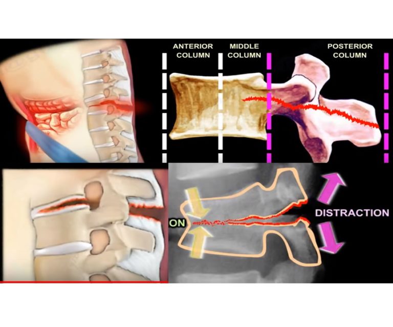 Flexion Distraction Injury of the Spine — OrthopaedicPrinciples.com