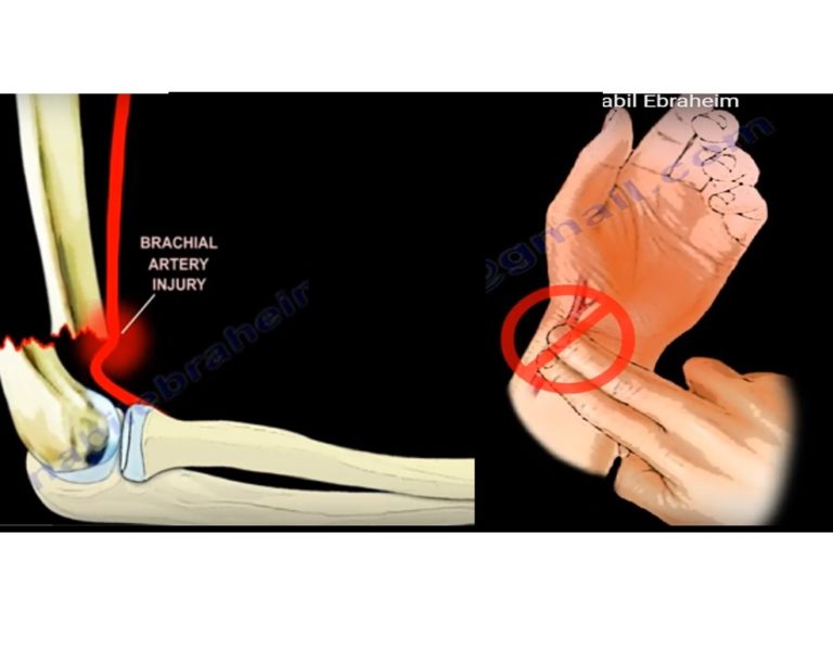 Vascular Injury in Supracondylar Humerus Fractures ...