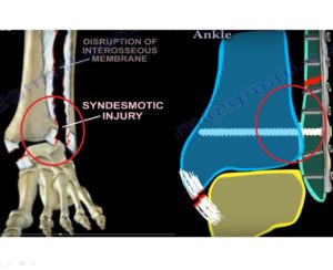 Syndesmotic Injuries to the Ankle — OrthopaedicPrinciples.com