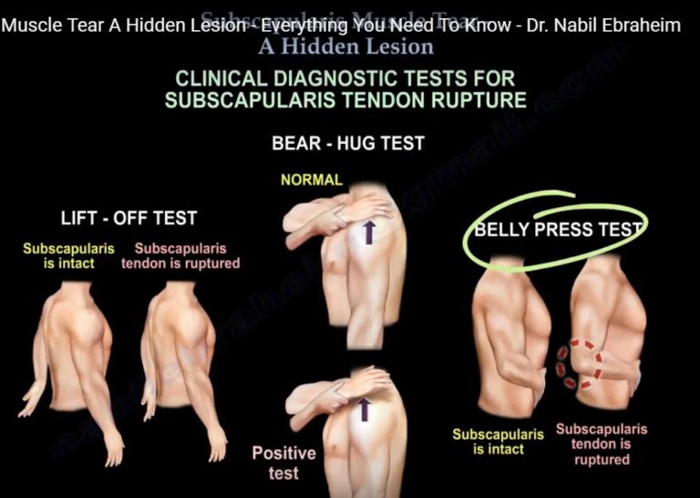 subscapularis-muscle-tear-orthopaedicprinciples