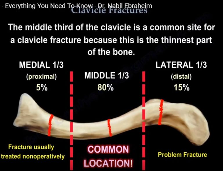 Clavicle Fractures, Symptoms, Types, Diagnosis — OrthopaedicPrinciples.com