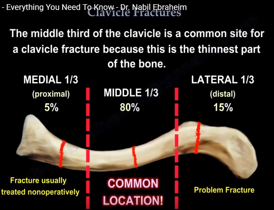 What is the approach to a midshaft clavicle fracture?