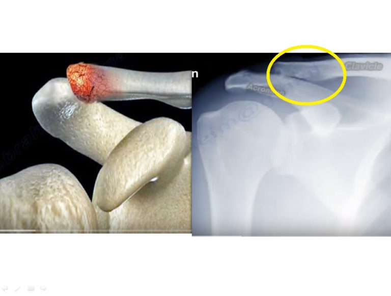 Osteolysis Of The Distal End Of Clavicle —