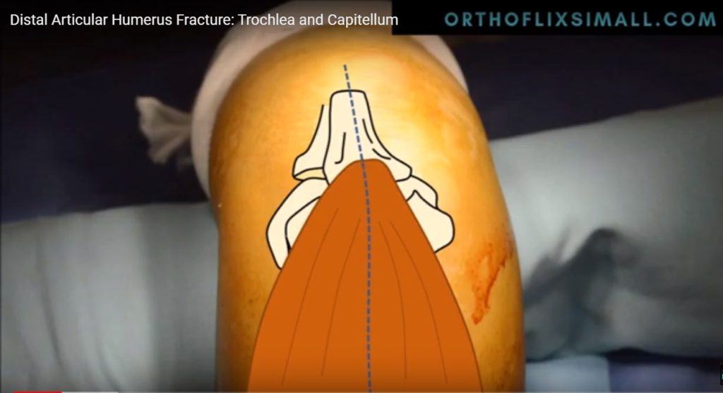 Distal Humerus Articular Fracture Orthopaedicprinciples Com