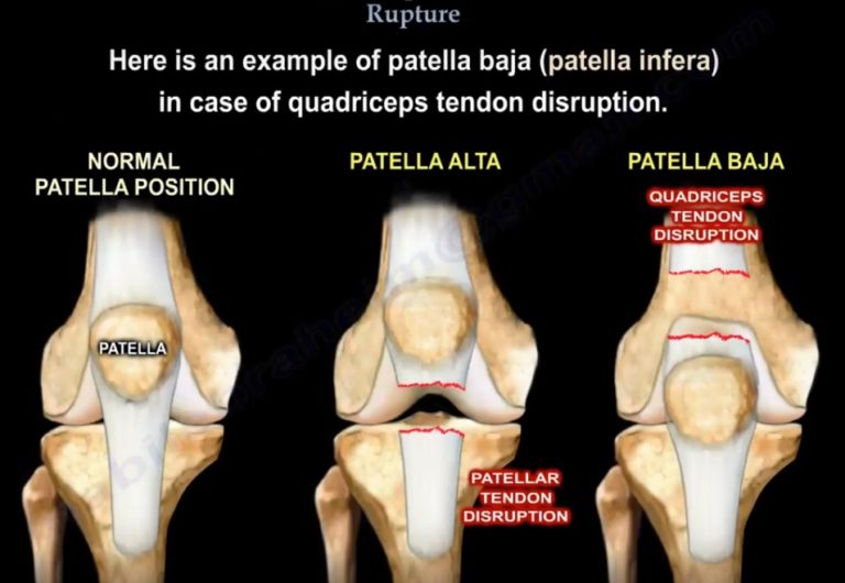 quadriceps-tendon-rupture-orthopaedicprinciples