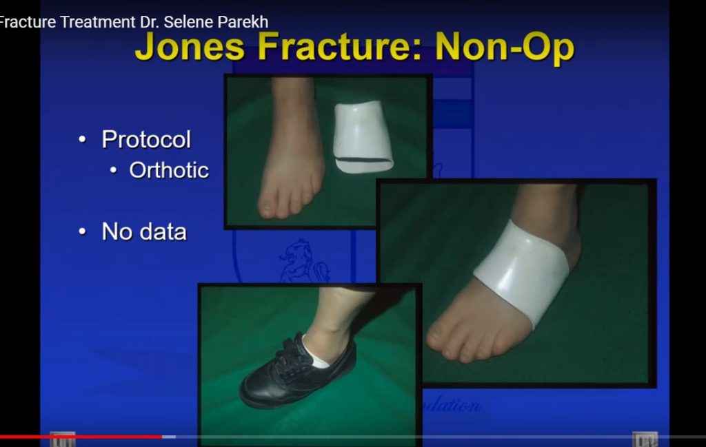 jones fracture treatment