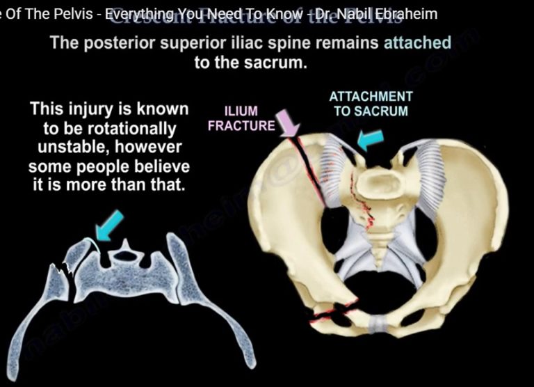 Crescent Fracture Of The Pelvis — OrthopaedicPrinciples.com