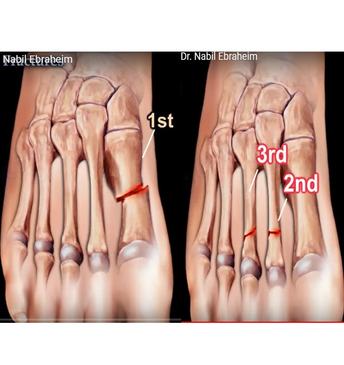 cureus-surgical-realignment-of-a-dorsiflexed-metatarsal-fracture