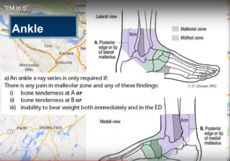 Ottawa Rules for Knee and Ankle — OrthopaedicPrinciples.com