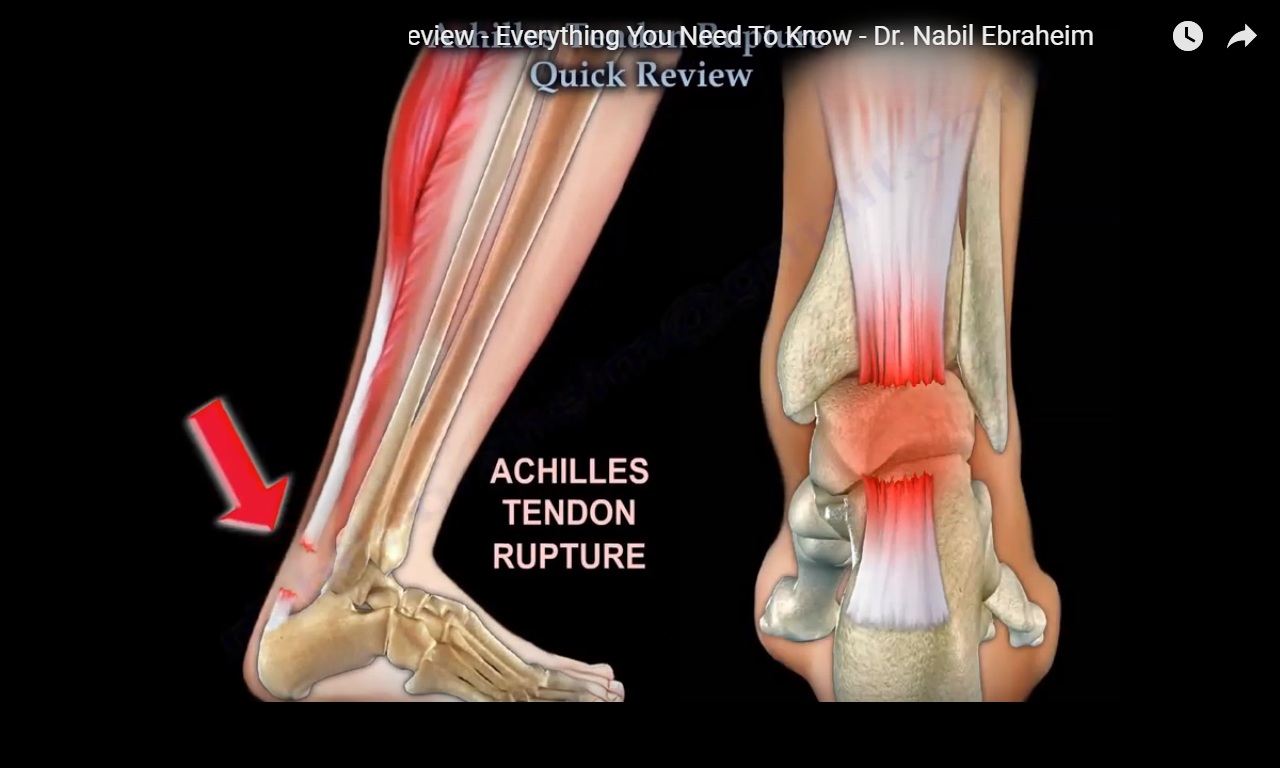 Achilles Tendon Rupture Sign