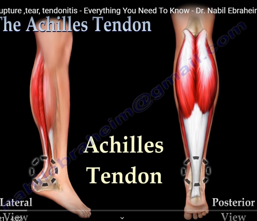Thompson Test for Achilles tendon tear