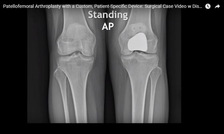 Patellofemoral Arthroplasty With A Custom, Patient-Specific Device ...