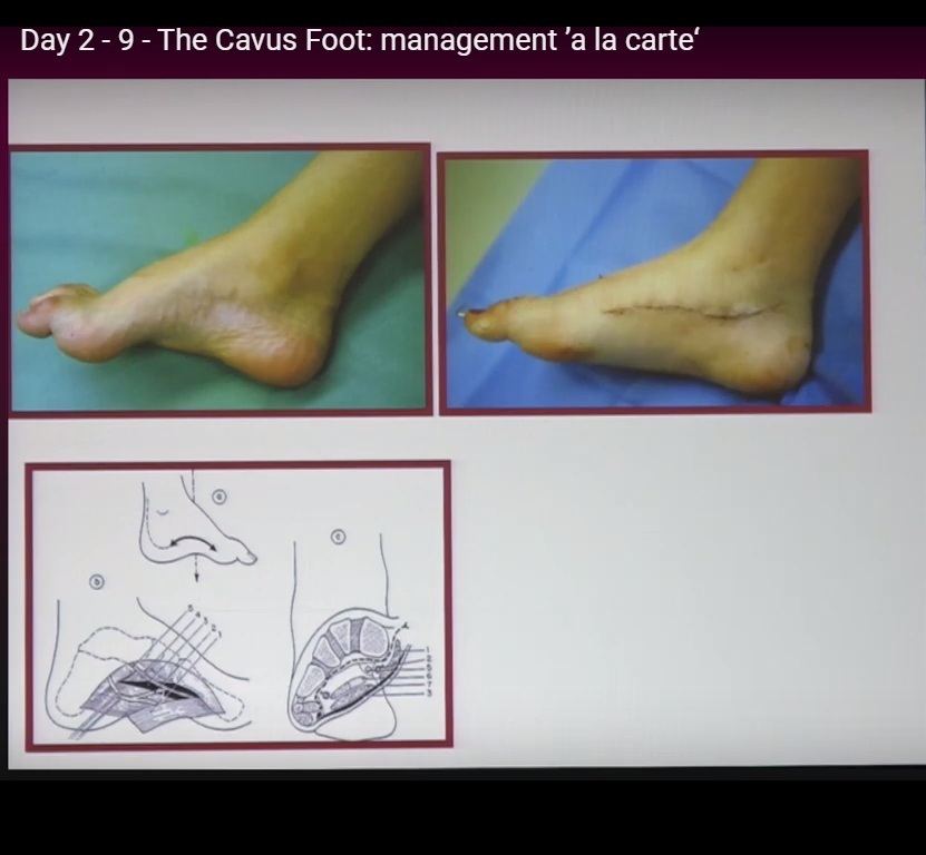 A La Carte Approach To Cavus Feet Orthopaedicprinciples Com