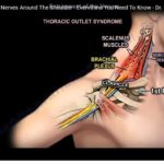 Neuralgic Pain in Upper Extremity