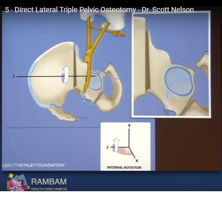 Direct Lateral Triple Pelvic Osteotomy —