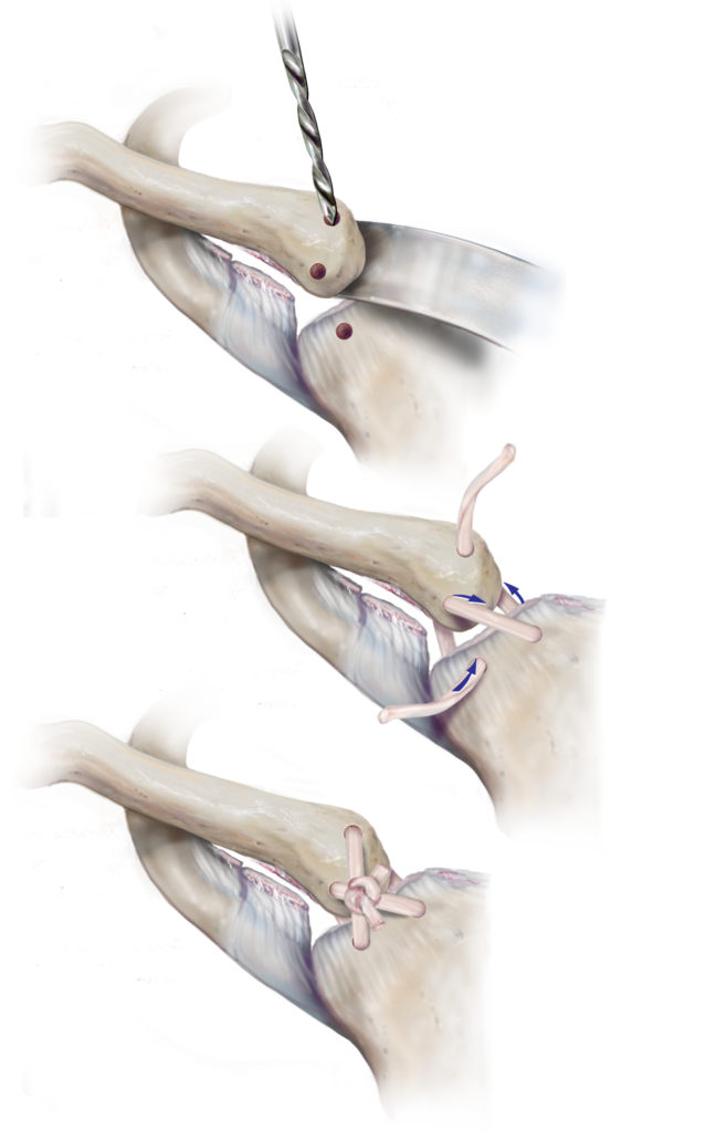 Sternoclavicular Ligament Reconstruction Orthopaedicprinciples Com