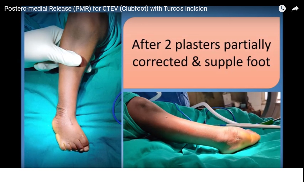 The Turco Procedure for Late Presenting Clubfoot —