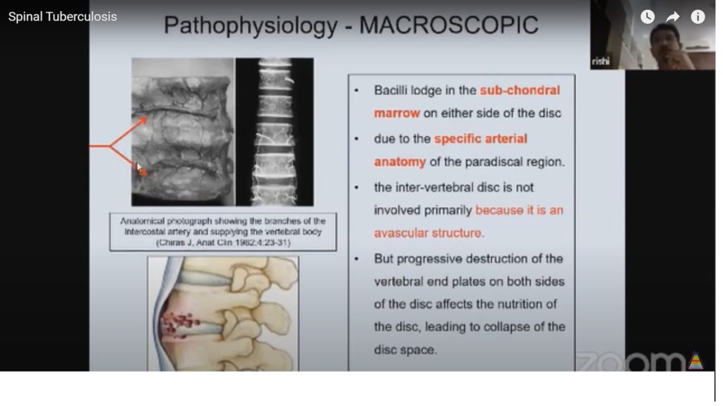 Tuberculosis of the Spine — OrthopaedicPrinciples.com