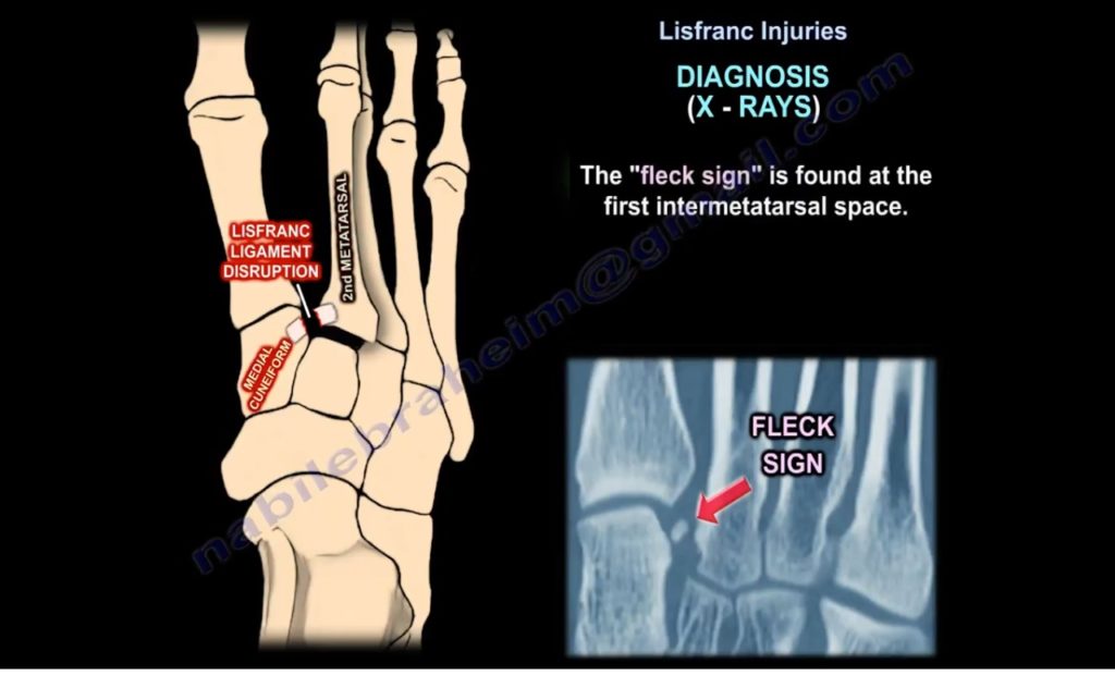 school leave for hand fracture