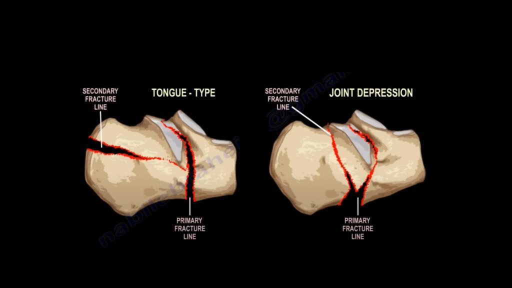 Calcaneal Fractures- An Overview — OrthopaedicPrinciples.com