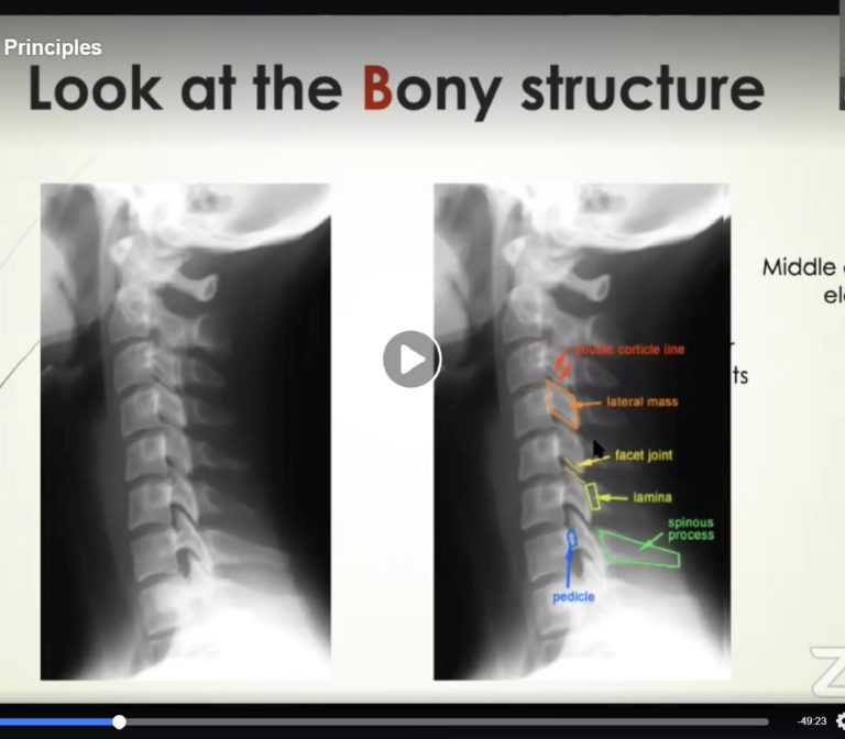 cervical-spine-injury-orthopaedicprinciples