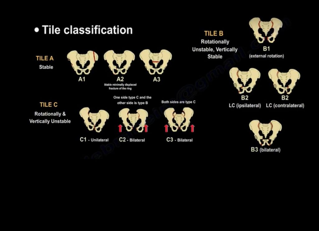 Classification Of Pelvic Fracture