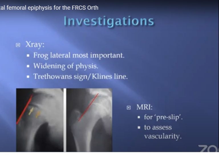 slipped-capital-femoral-epiphysis-orthopaedicprinciples