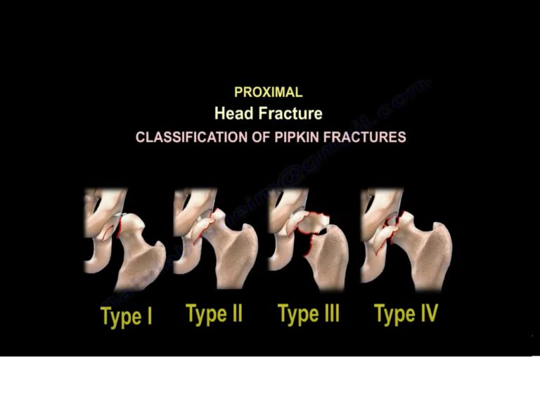 Spectrum of Femur fractures — OrthopaedicPrinciples.com