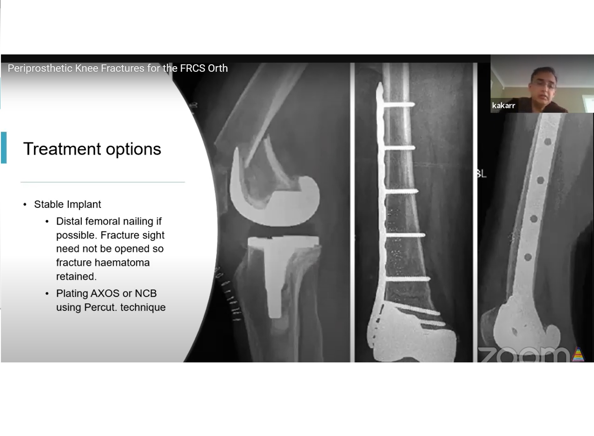 Pdf Periprosthetic Fractures Following Total Knee Arthroplasty | My XXX ...