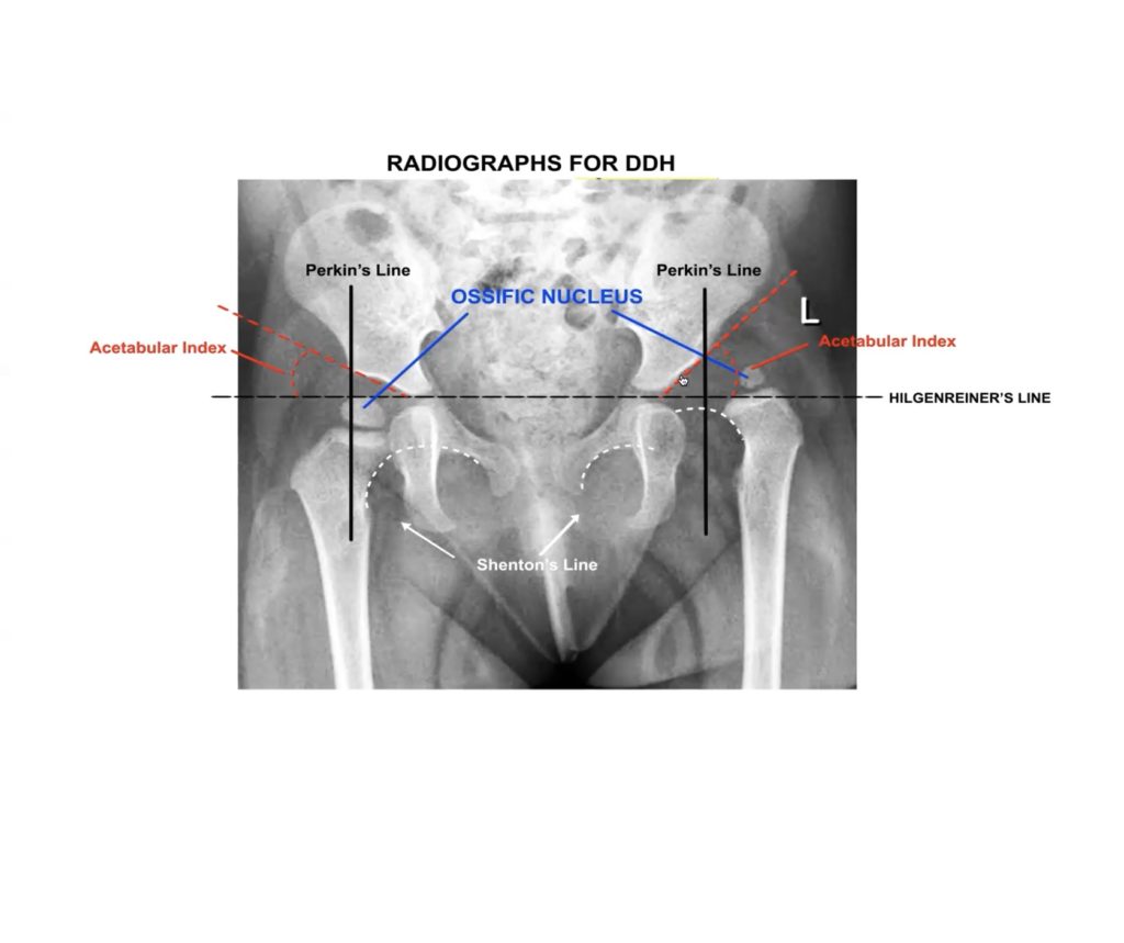 Developmental Dysplasia of Hip for FRCS Orth — OrthopaedicPrinciples.com