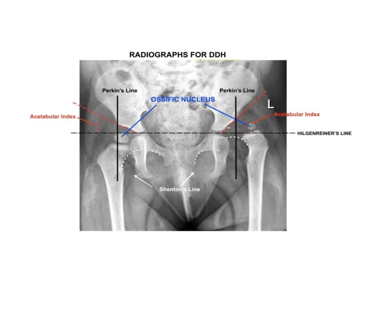 Developmental Dysplasia Of Hip For Frcs Orth — Orthopaedicprinciples.com