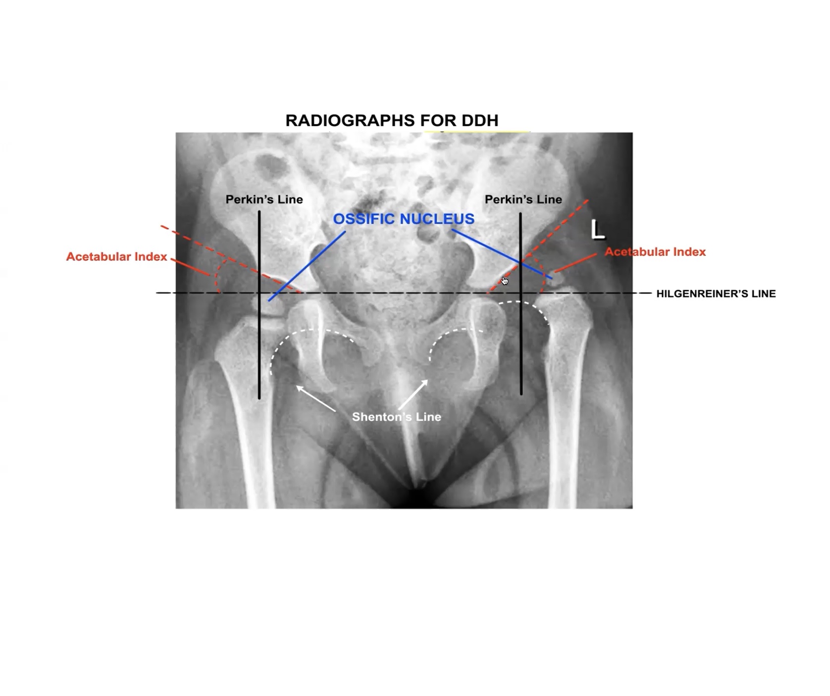 Developmental Dysplasia Of The Hip X Ray