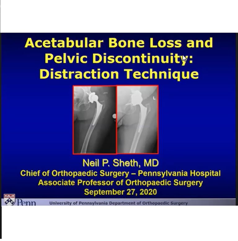 Acetabular Bone Loss And Pelvic Discontinuity- The Distraction ...