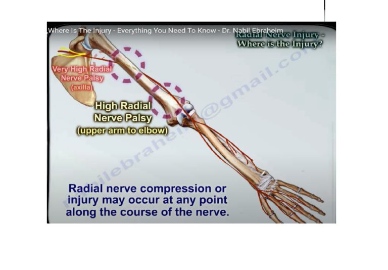 How to localise Radial Nerve Injury? —