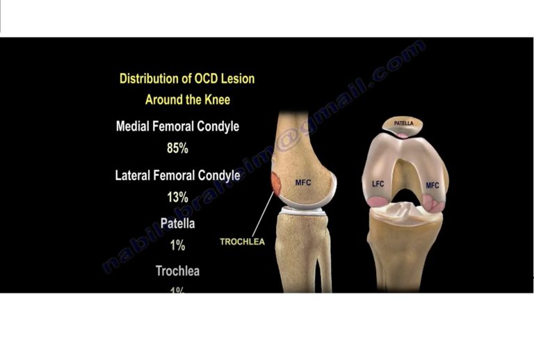 Osteochondritis Dissecans Of The Knee — OrthopaedicPrinciples.com