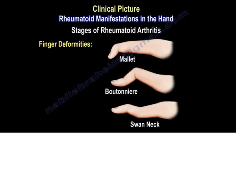 Rheumatoid Arthritis Of The Hand — OrthopaedicPrinciples.com