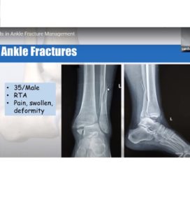 Ankle Fracture Management 272x300 