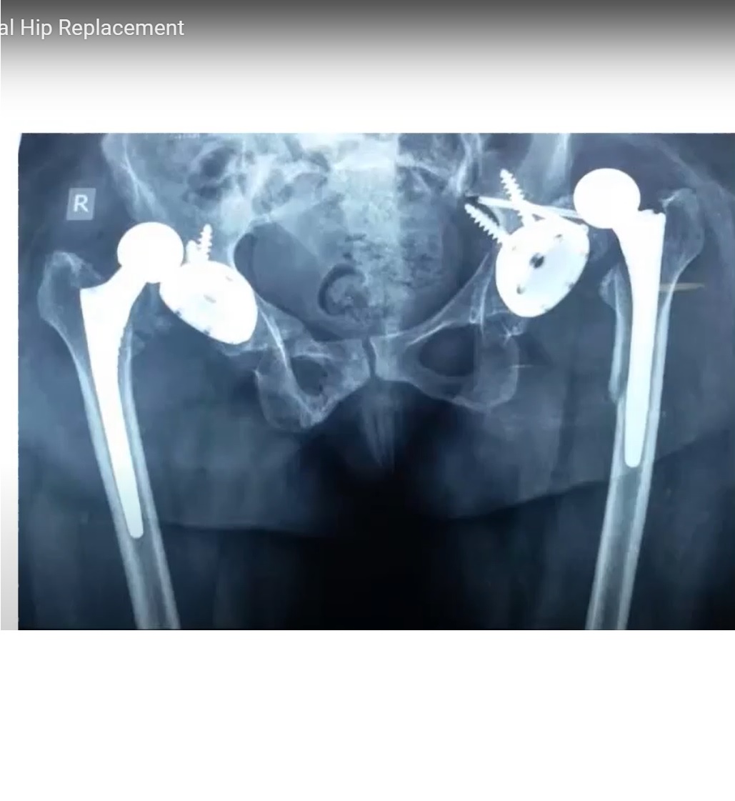 Dislocation After Total Hip Replacement — 