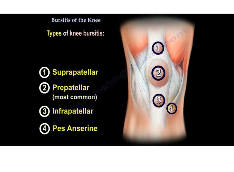 Bursitis Of Knee — OrthopaedicPrinciples.com