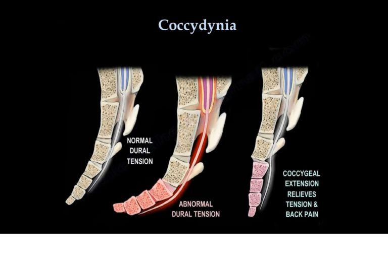 coccydynia-orthopaedicprinciples