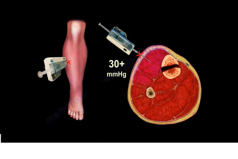 Compartment Syndrome Diagnosis And Treatment OrthopaedicPrinciples