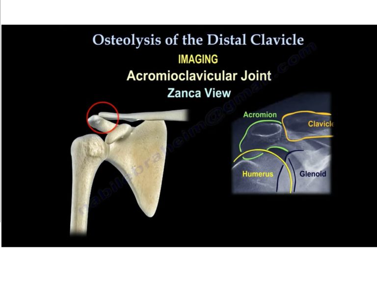 Osteolysis of the Distal Clavicle — OrthopaedicPrinciples.com