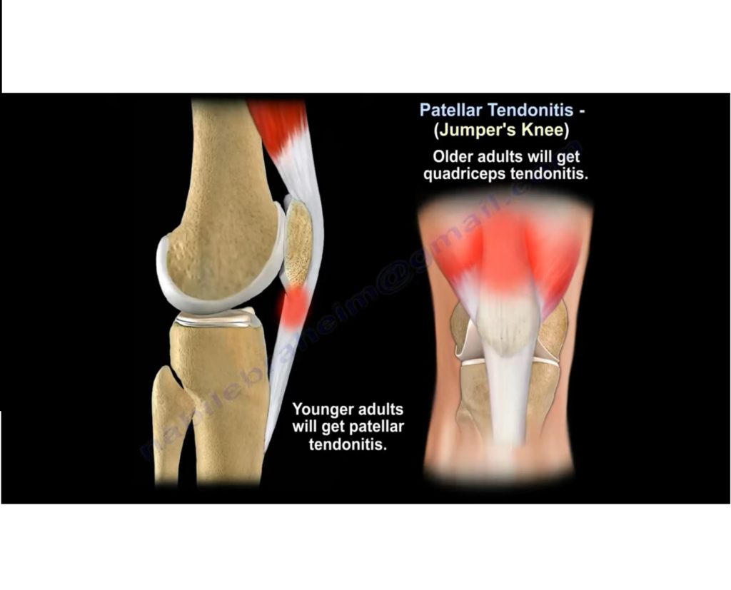 Patellar Tendinitis-Jumper’s Knee — OrthopaedicPrinciples.com