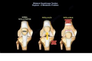 Bilateral Quadriceps Tendon Rupture — OrthopaedicPrinciples.com