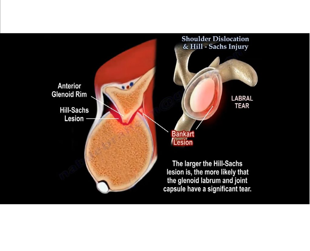 shoulder-dislocation-and-hill-sach-s-lesion-orthopaedicprinciples