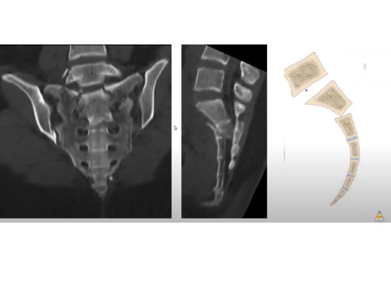 Transverse Sacral Fracture — 