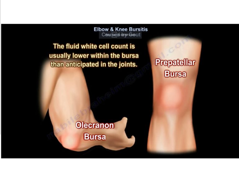 Elbow And Knee Bursitis Caused By Gout — OrthopaedicPrinciples.com