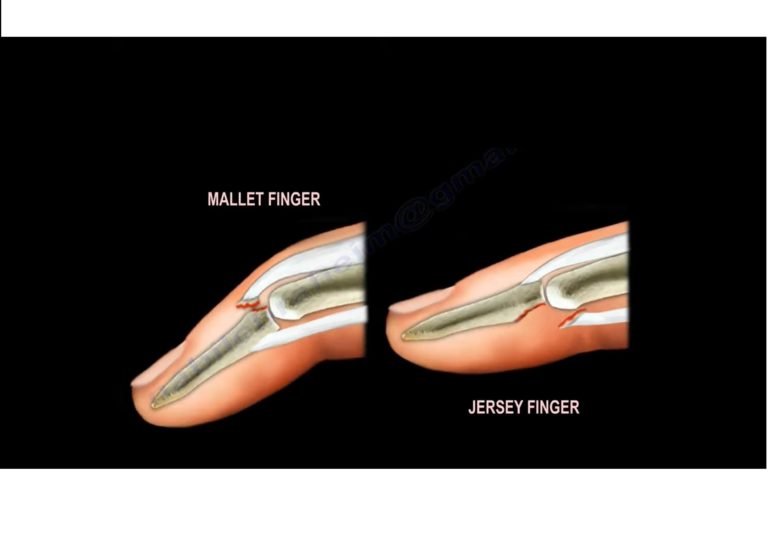 mallet-and-jersey-fingers-orthopaedicprinciples